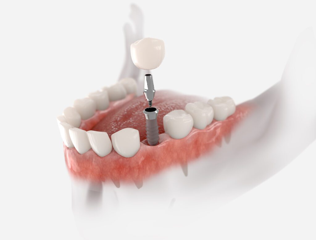 Dental Implant in Plano, TX