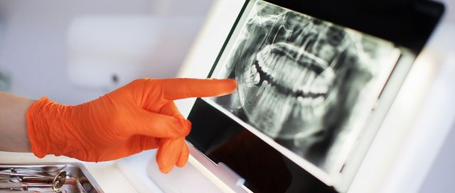How to Evaluate Tooth Pulp Vitality